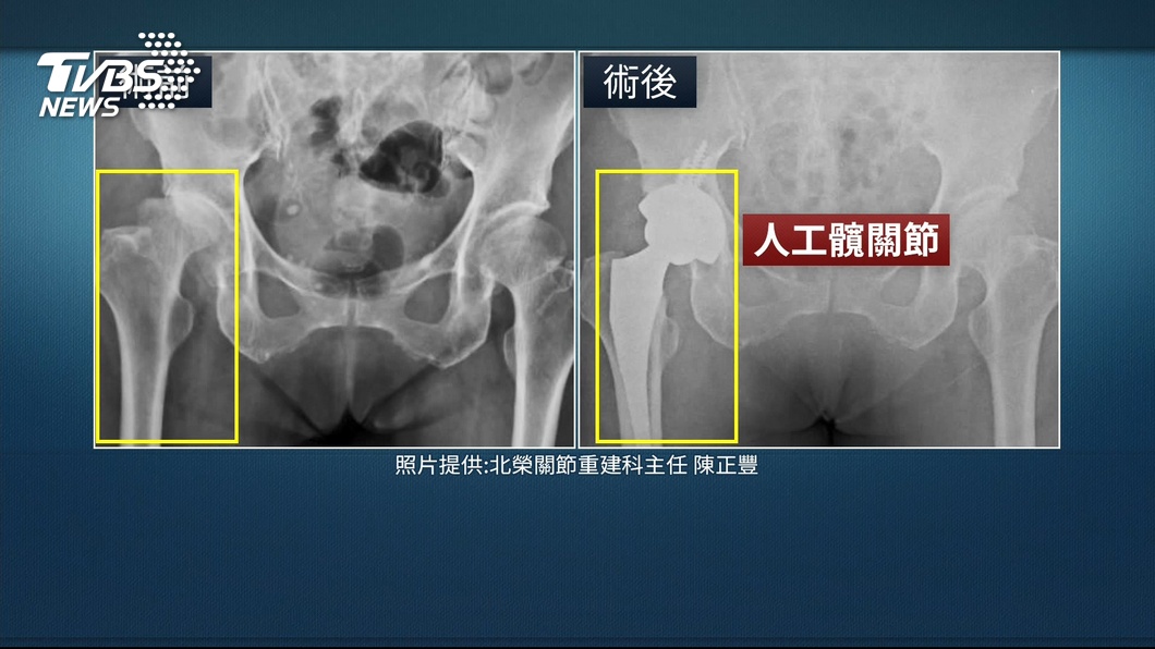 人工髖關節術前術後