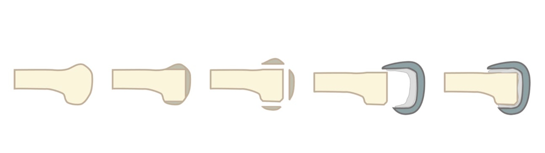 大腿骨(股骨)側面照