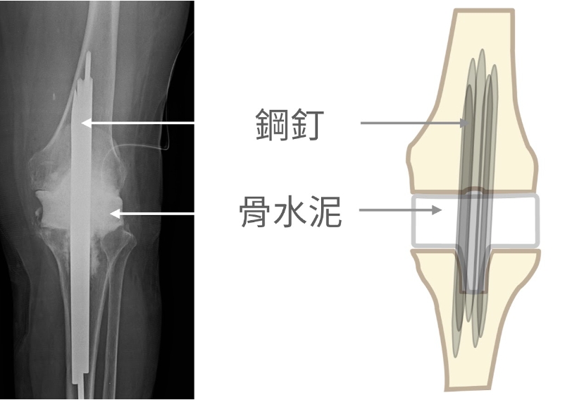 拔除人工關節,置放含抗生素的骨水泥假體術後 X 光片