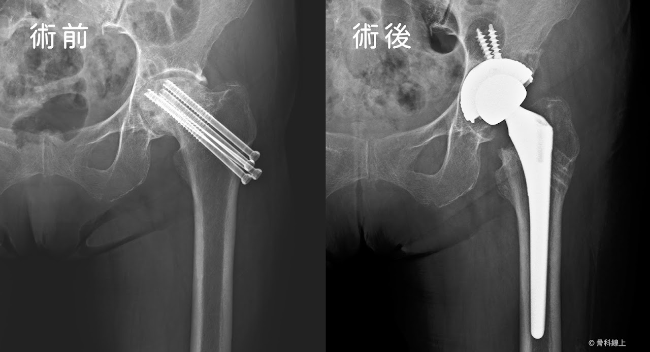 創傷性股骨頭缺血性壞死接受人工髖關節置換手術