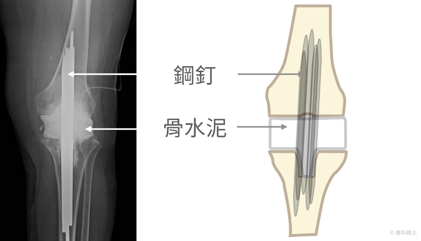 拔除人工關節,置放含抗生素的骨水泥假體術後 X 光片