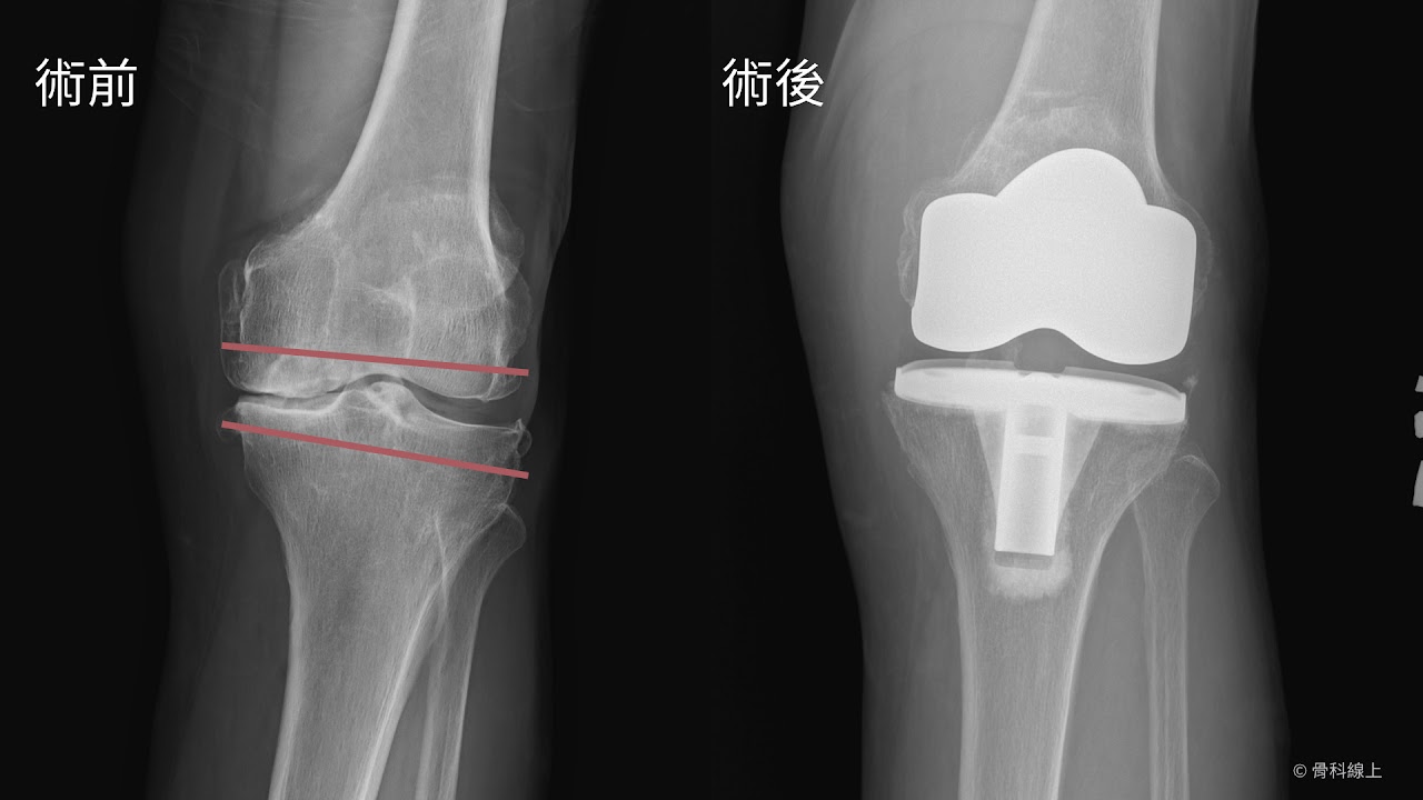 人工膝關節術前後X光