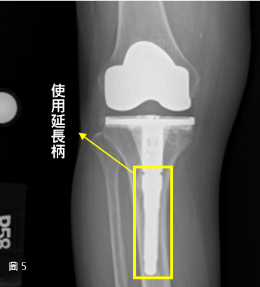 手術後 - 全人工膝關節再次置換