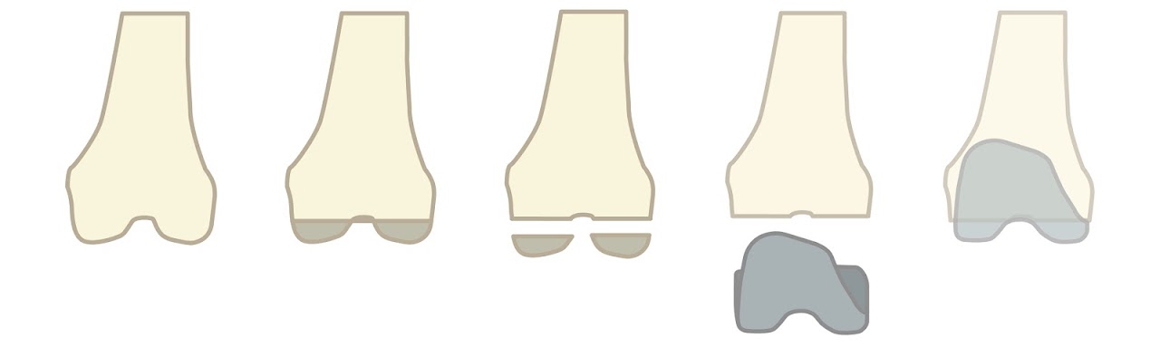 全人工膝關節置換-股骨手術過程示意圖