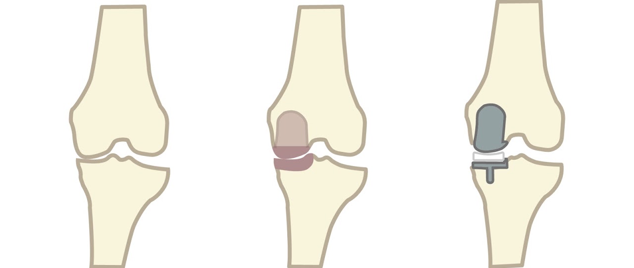 部分人工膝關節置換手術過程示意圖