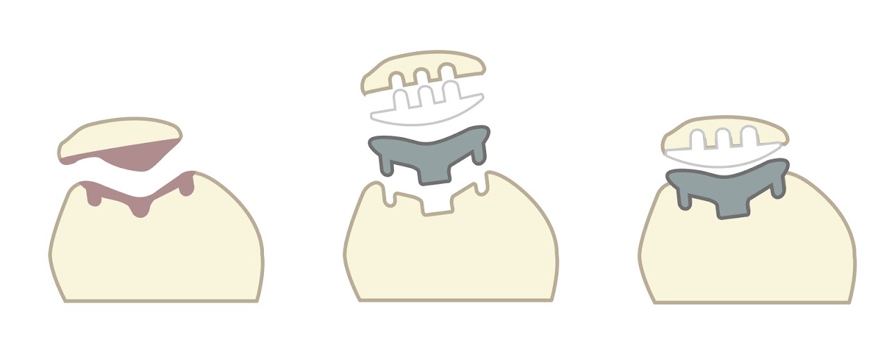 髕骨股骨人工膝關節置換手術過程示意圖