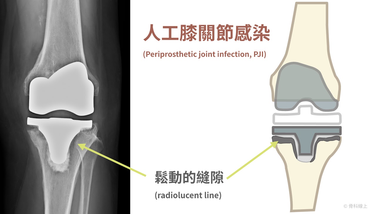 X 光片上一樣可以出現表示鬆動的“黑線”