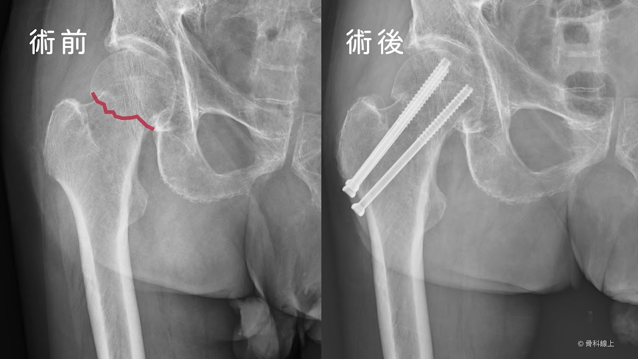 股骨頸骨折術前術後