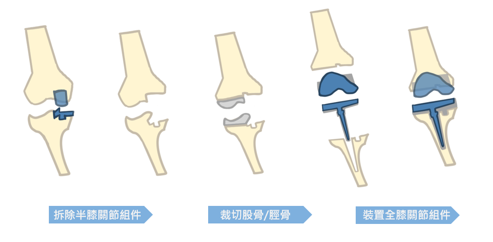 半膝關節置換術後再次置換手術示意圖