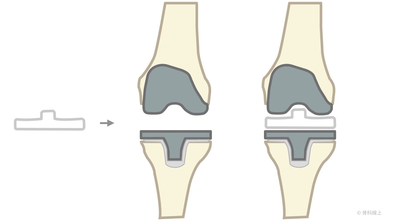 全人工膝關節置換-關節組裝過程示意圖
