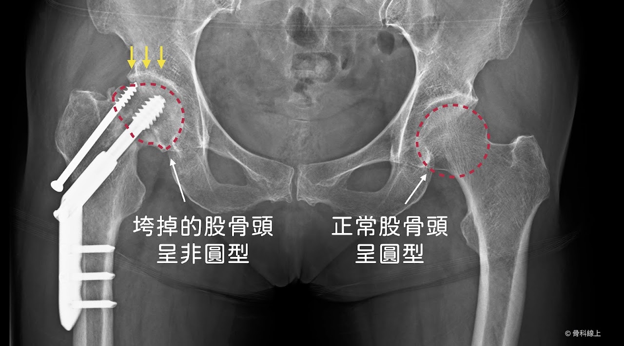 股骨頸骨折手術固定後發生股骨頭壞死