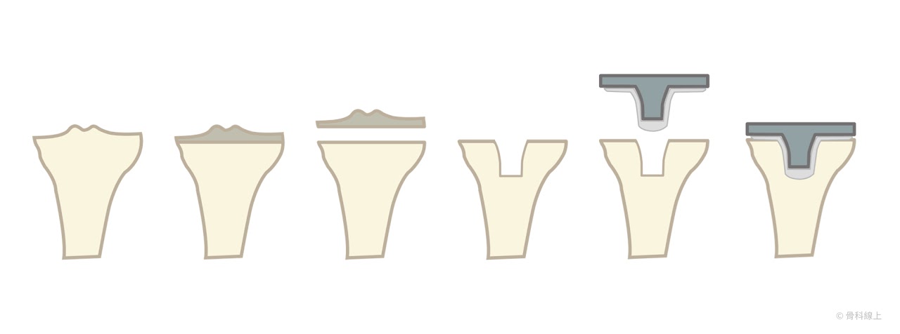 小腿骨(脛骨)正面照