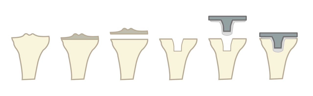 全人工膝關節置換-脛骨手術過程示意圖