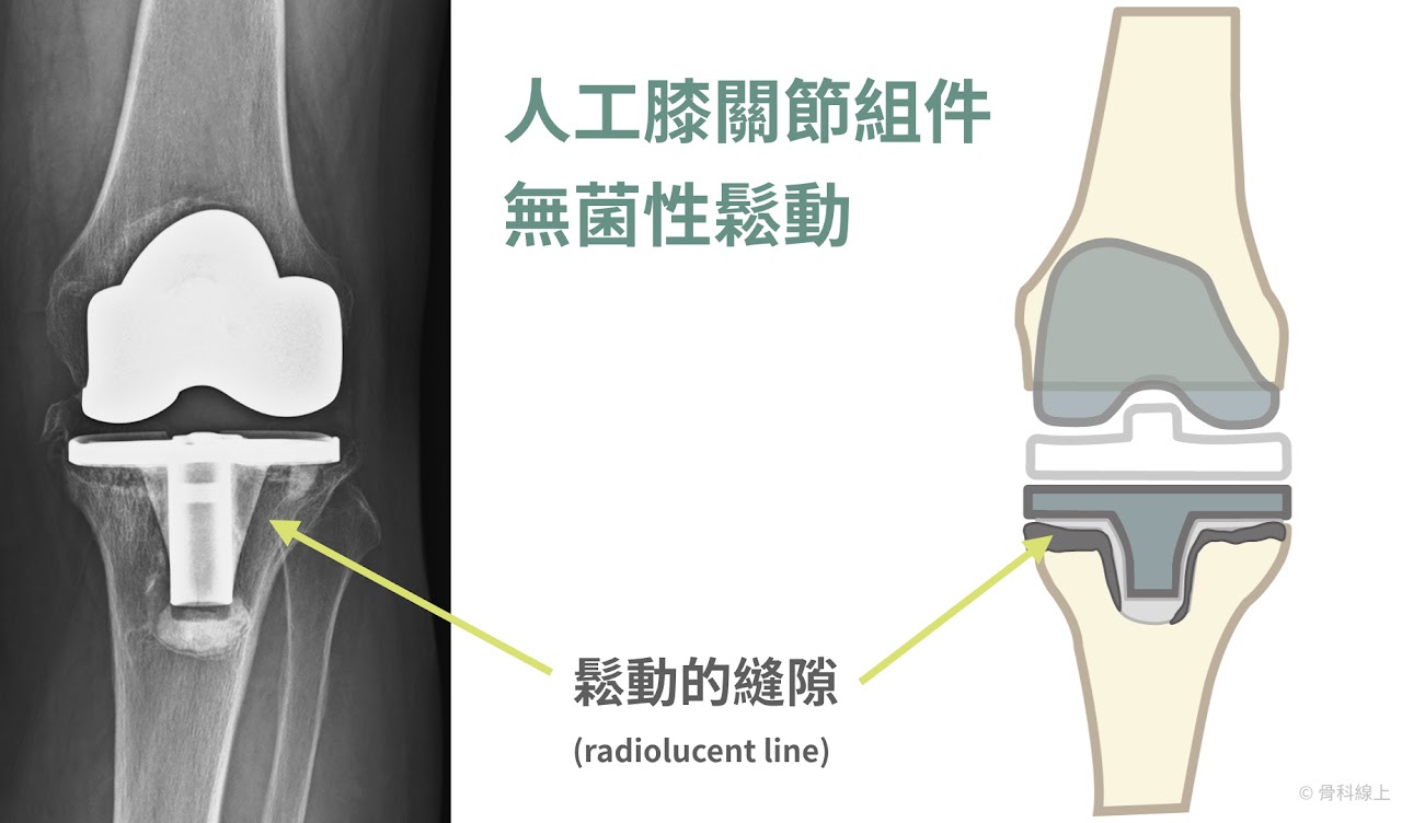 人工膝關節組件無菌性鬆動