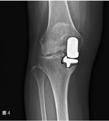 手術前 - 半膝關節組件鬆動
